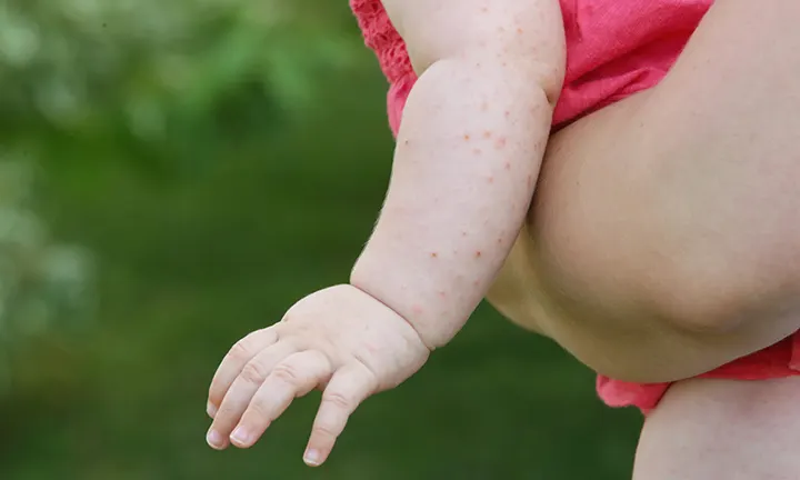 A baby's arm covered in Heat Rash (Prickly Heat). Small red bumps, especially in areas where sweat collects, like the neck, armpits, and skin folds.