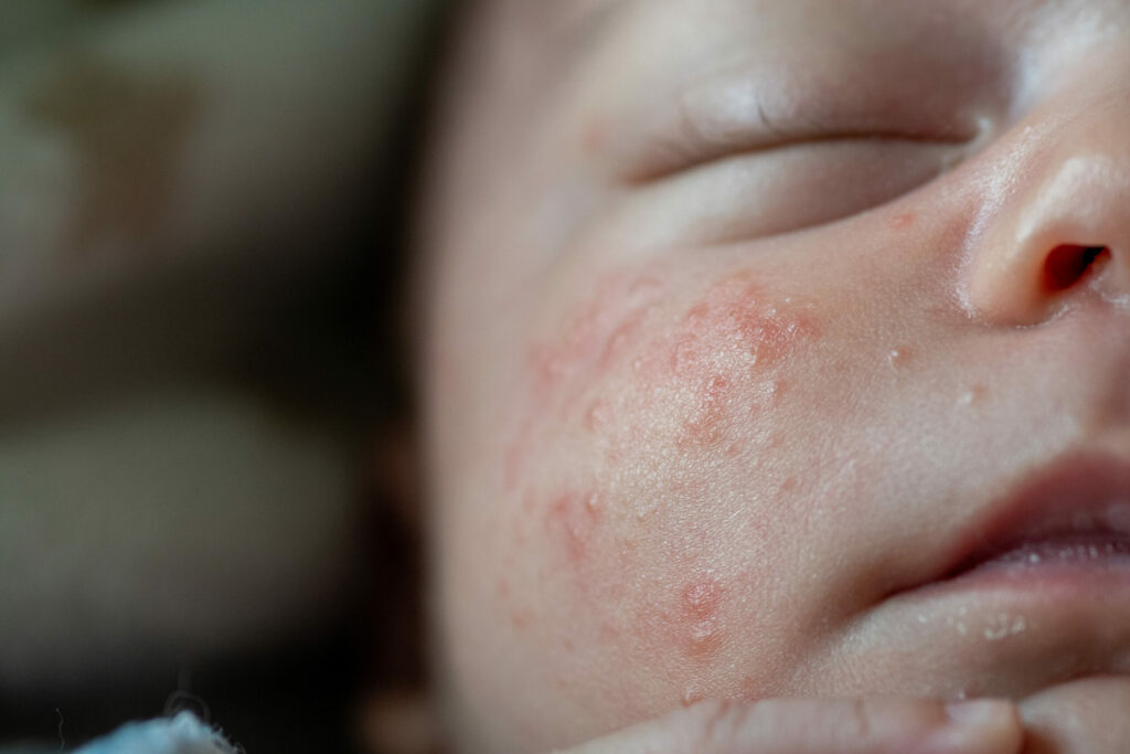A close-up of a baby's face riddled with baby acne all over their cheeks.