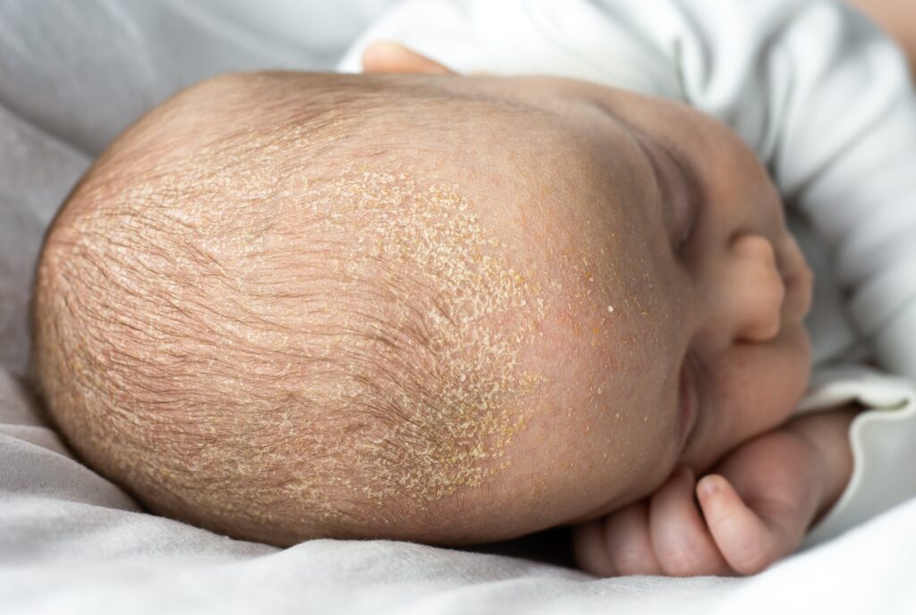An image of the head of a baby that has Cradle Cap (Seborrheic Dermatitis) a Yellowish, patchy, greasy, scaly patches on the baby's scalp.