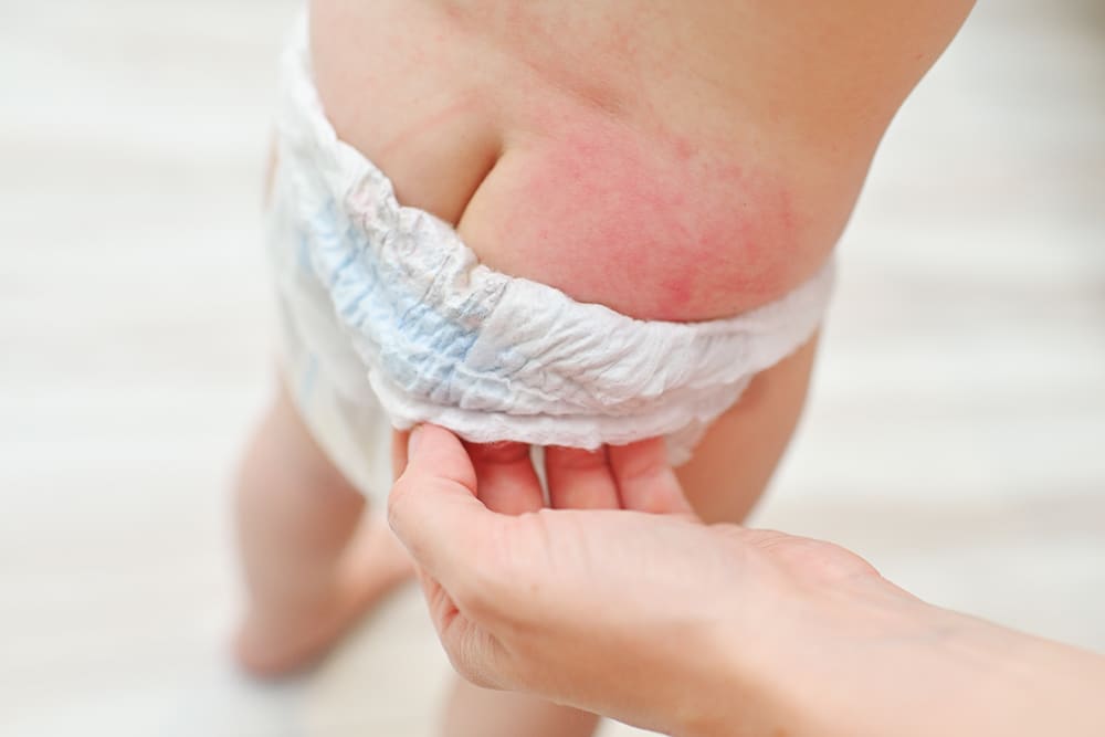 An image of a baby's butt with Diaper Rash. There's Red, puffy, shiny skin in the diaper area.