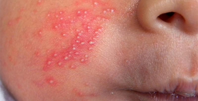 An image of a baby's cheek with Erythema Toxicum, it's Reddish patches with yellow or white raised centers, often appearing 2-5 days after birth.