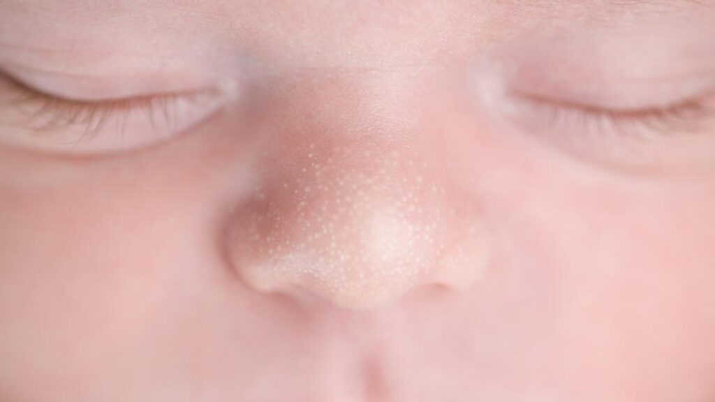 A close-up of an image of a baby's nose with Tiny white bumps on the nose, chin, or cheeks.